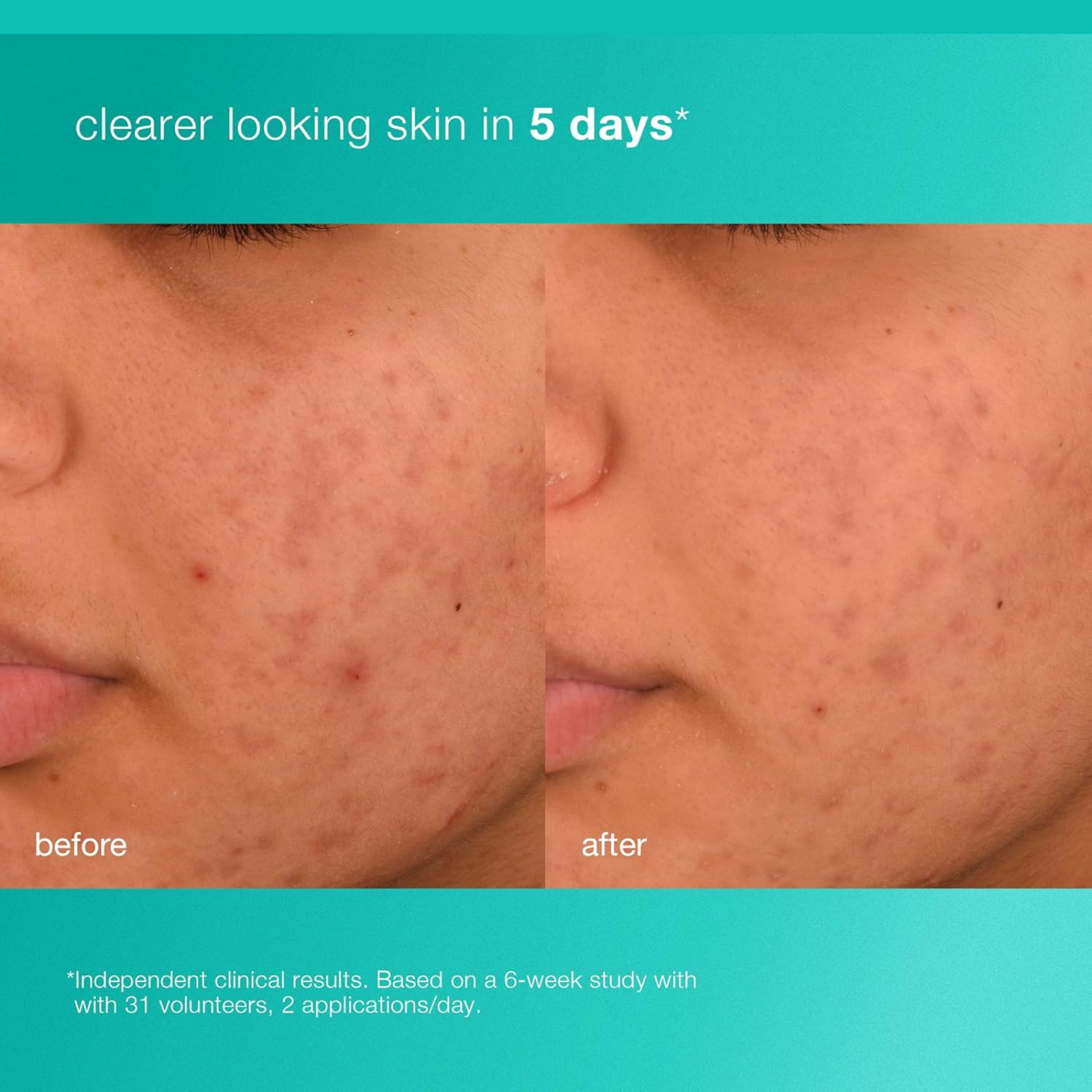 Dermalogica Acne Biotic Moisturizer (Acne-balancing moisturizer)